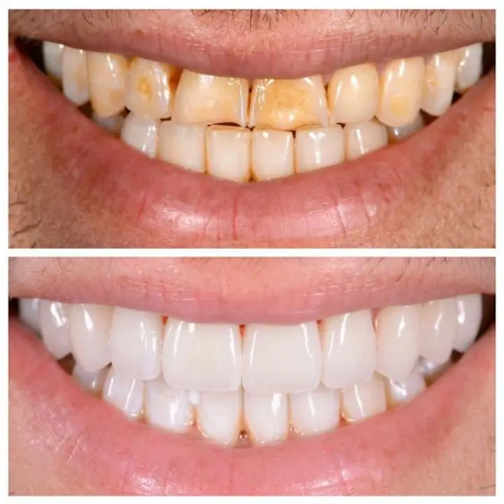 First finished Porcelain Veneers Sydney image ad
