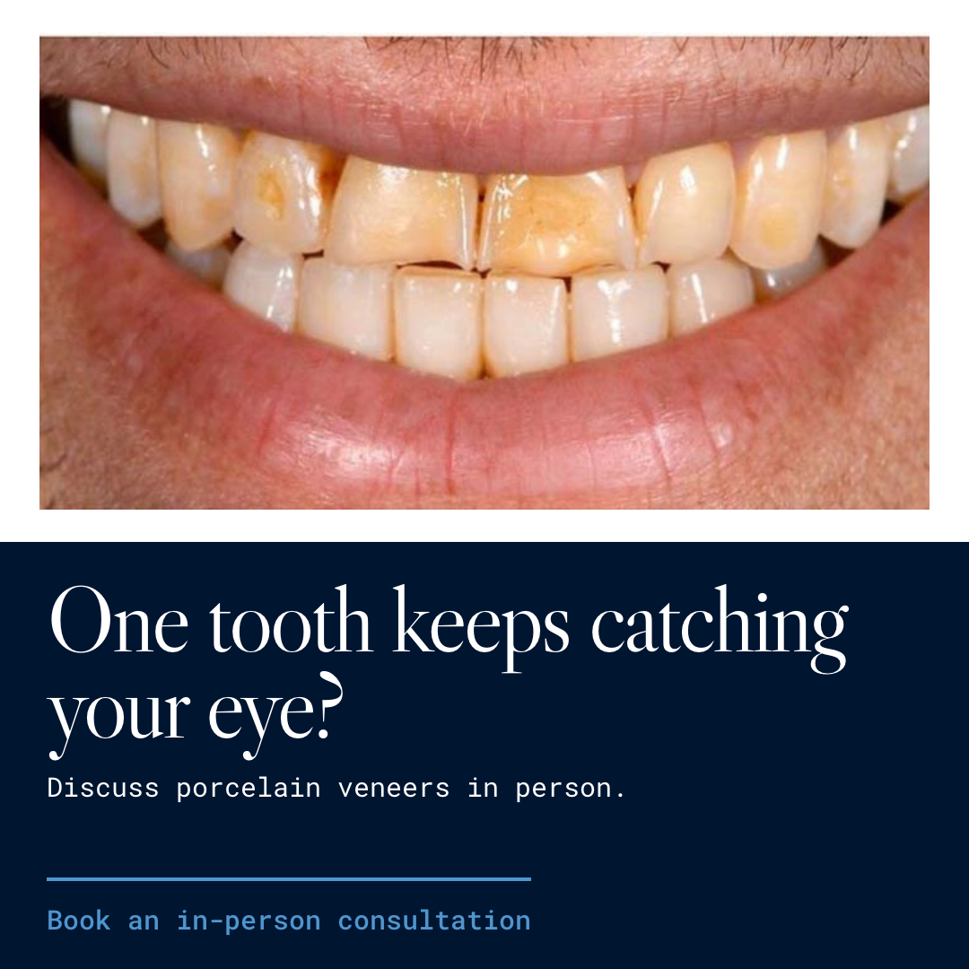 First finished Porcelain Veneers Sydney image ad