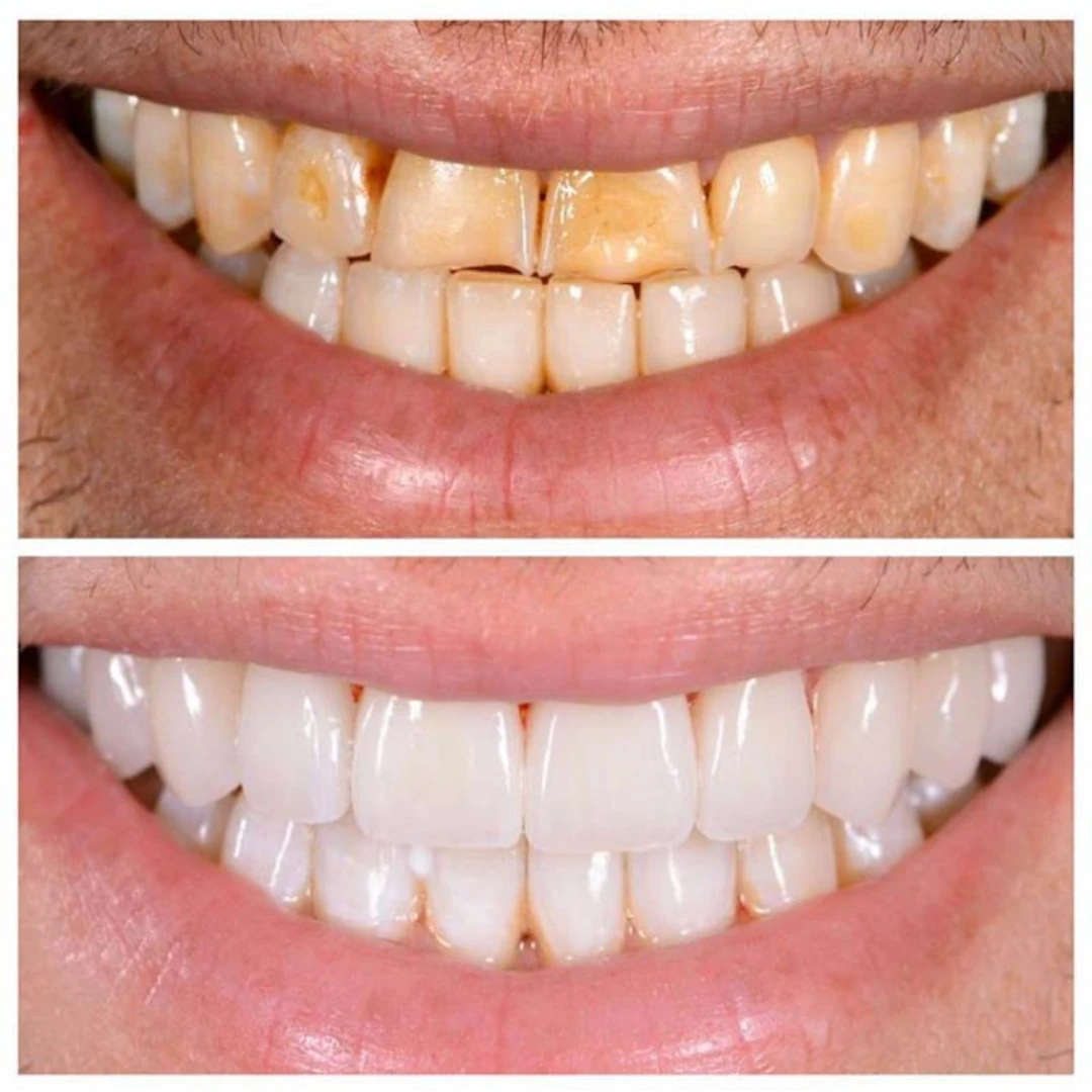 Porcelain veneers, your way ad creative