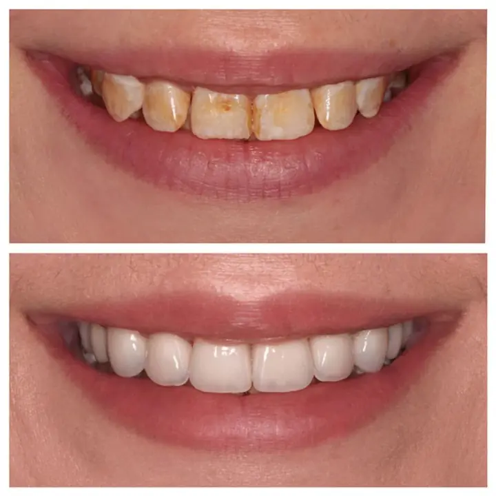 Second finished Porcelain Veneers Sydney image ad